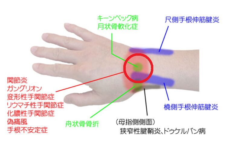 傷む箇所は手首の真ん中